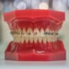 Are You a Candidate for Full Mouth Dental Implants Key Factors Explained