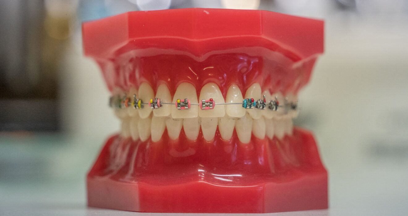 Are You a Candidate for Full Mouth Dental Implants Key Factors Explained