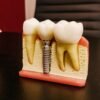 Single Tooth Implants