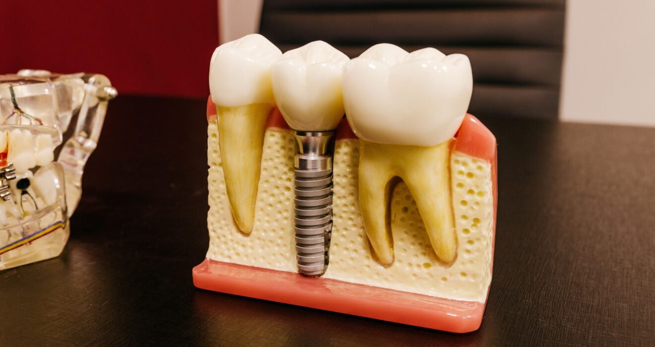 Single Tooth Implants