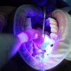 Reasons-for-bleeding-gums-and-treatment-in-coimbatore-scaled
