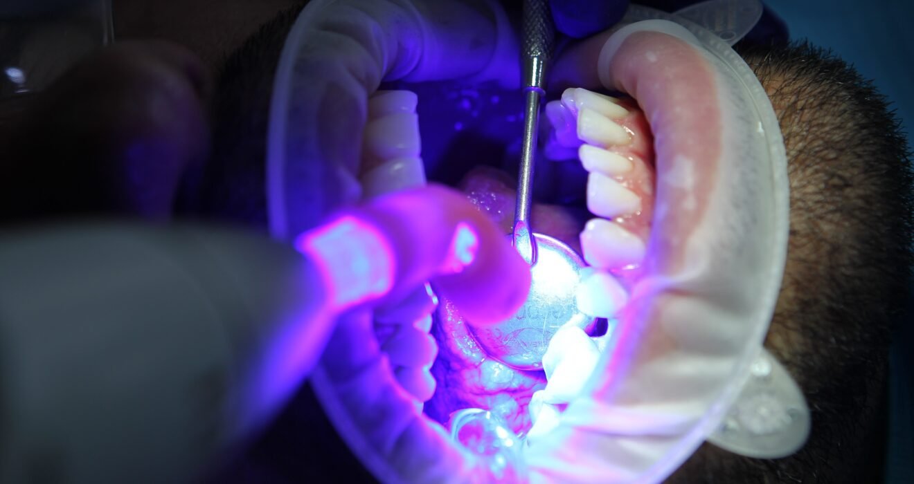 Reasons-for-bleeding-gums-and-treatment-in-coimbatore-scaled