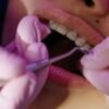 Teeth-Clip-Price-in-Coimbatore