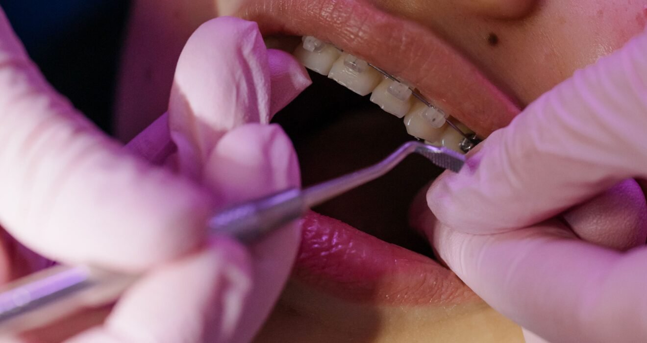 Teeth-Clip-Price-in-Coimbatore