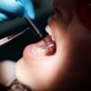 teeth scaling