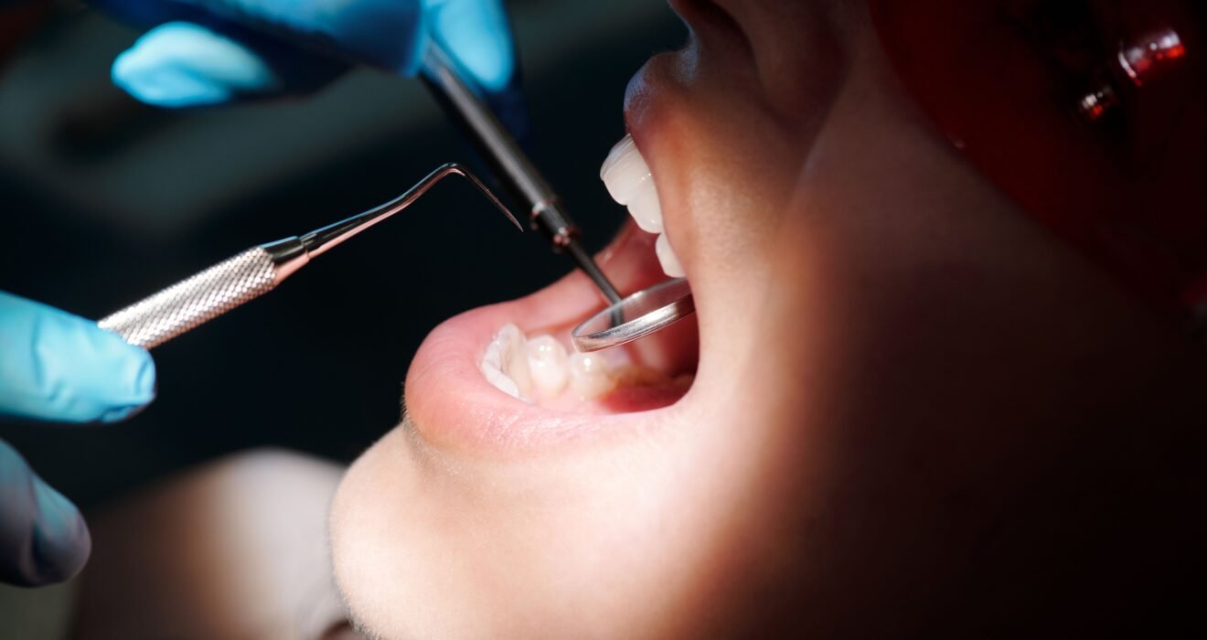 teeth scaling