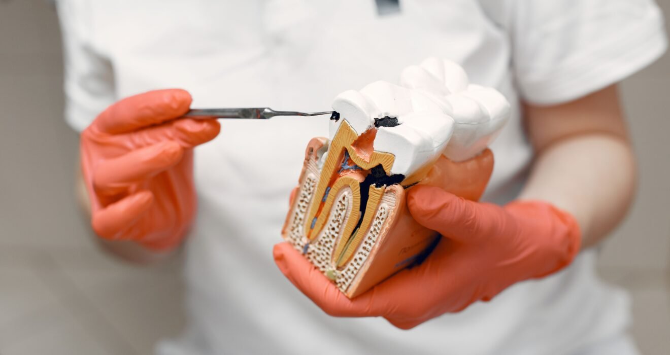 root canal