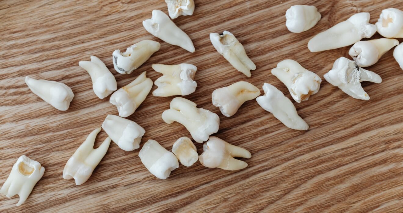 wisdom teeth