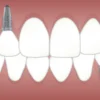 artificial teeth