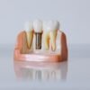 dental implant