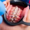 metal braces