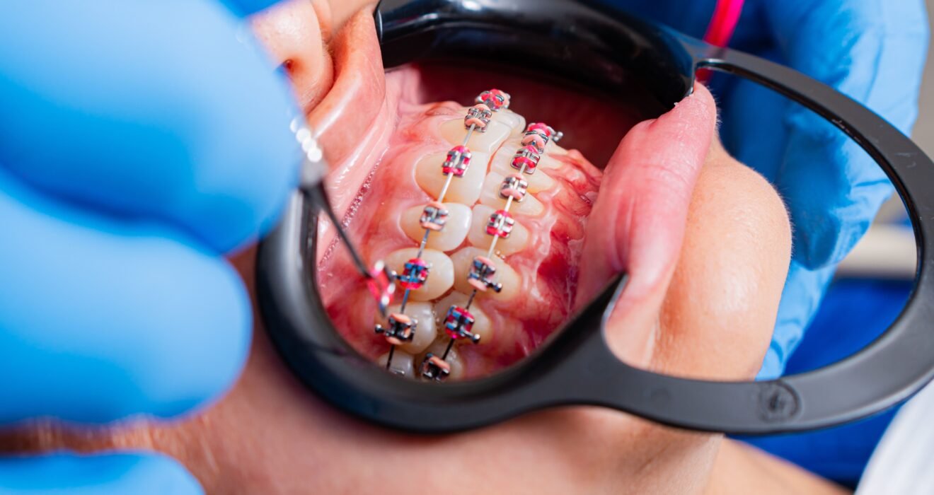 metal braces