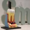 root canal