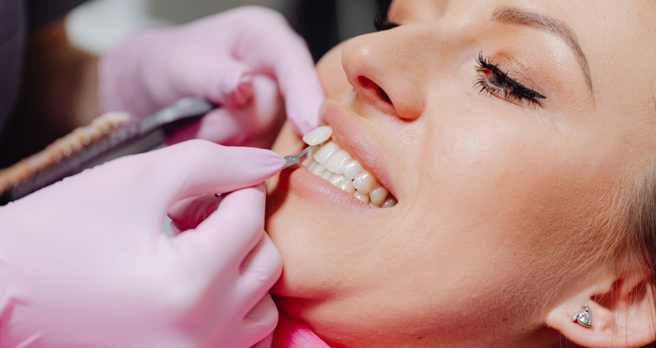 teeth whitening